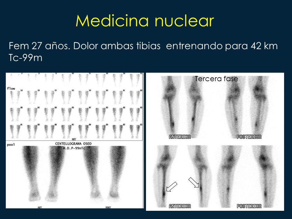 Medicina nuclear Fem 27 años. Dolor ambas tibias entrenando para 42 km