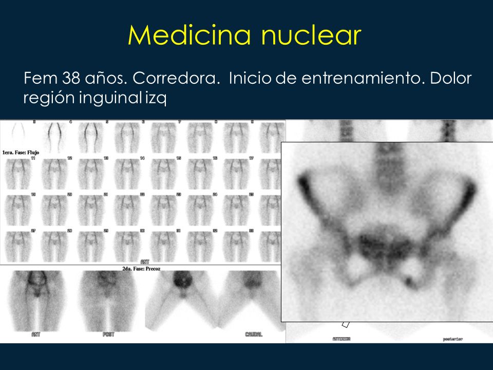 Medicina nuclear Fem 38 años. Corredora. Inicio de entrenamiento. Dolor región inguinal izq 26
