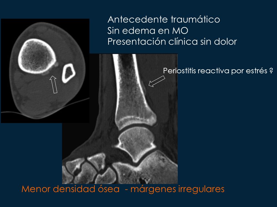 Antecedente traumático Sin edema en MO Presentación clínica sin dolor