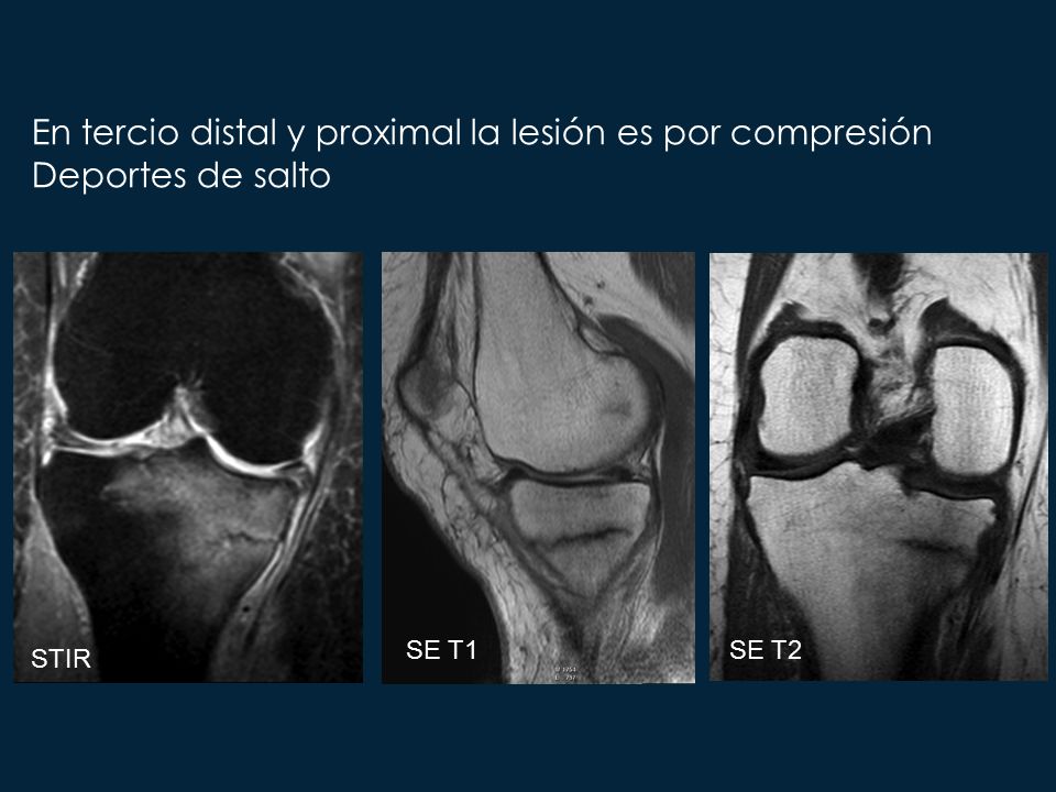 En tercio distal y proximal la lesión es por compresión