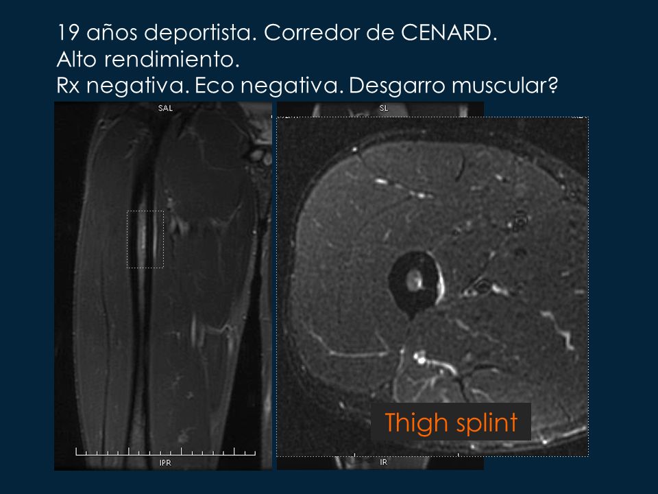 Thigh splint 19 años deportista. Corredor de CENARD. Alto rendimiento.