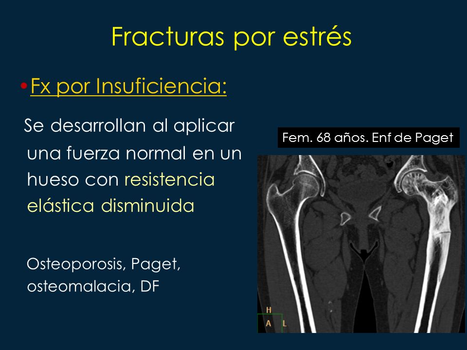 Fracturas por estrés Fx por Insuficiencia: Se desarrollan al aplicar una fuerza normal en un hueso con resistencia elástica disminuida.
