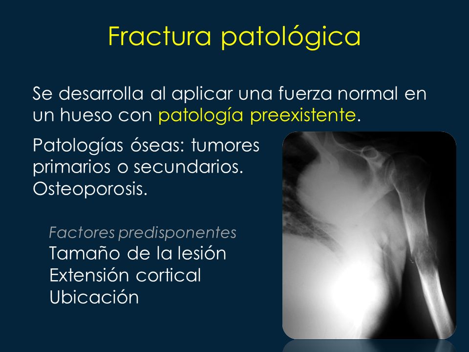 Fractura patológica Se desarrolla al aplicar una fuerza normal en un hueso con patología preexistente.