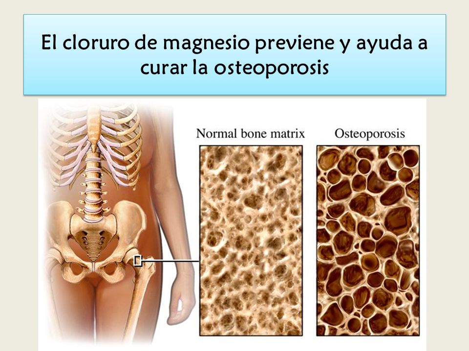 El cloruro de magnesio previene y ayuda a curar la osteoporosis