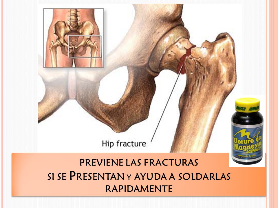 PREVIENE LAS FRACTURAS SI SE Presentan y AYUDA A SOLDARLAS RAPIDAMENTE
