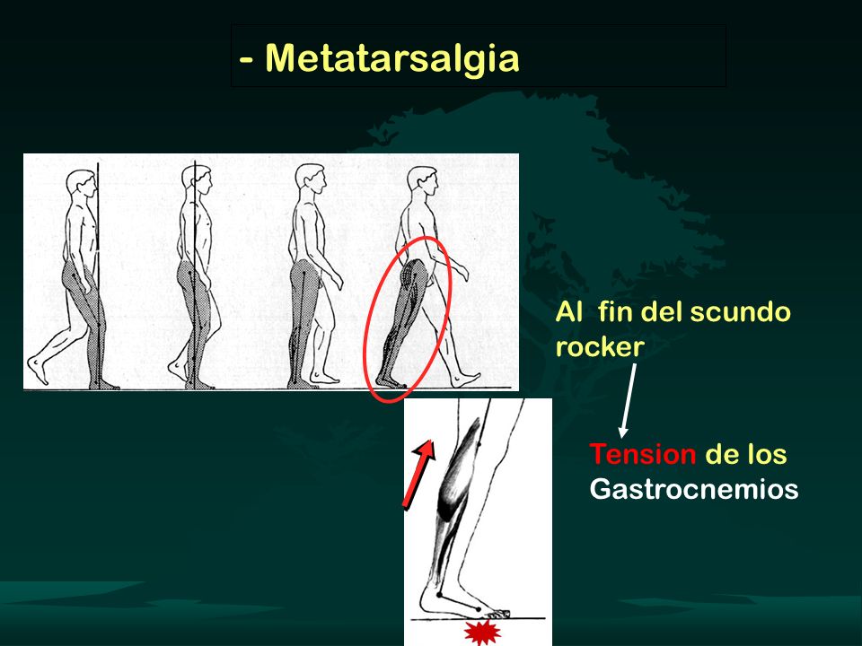 - Metatarsalgia Al fin del scundo rocker Tension de los Gastrocnemios