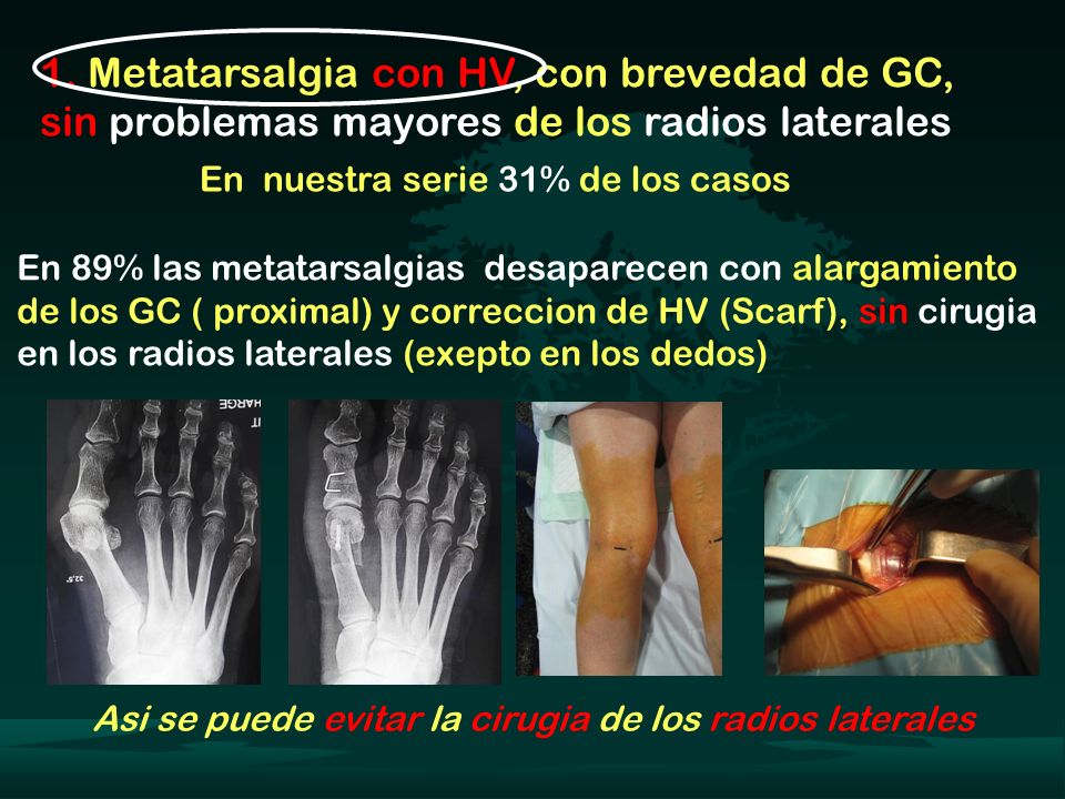 1. Metatarsalgia con HV, con brevedad de GC, sin problemas mayores de los radios laterales