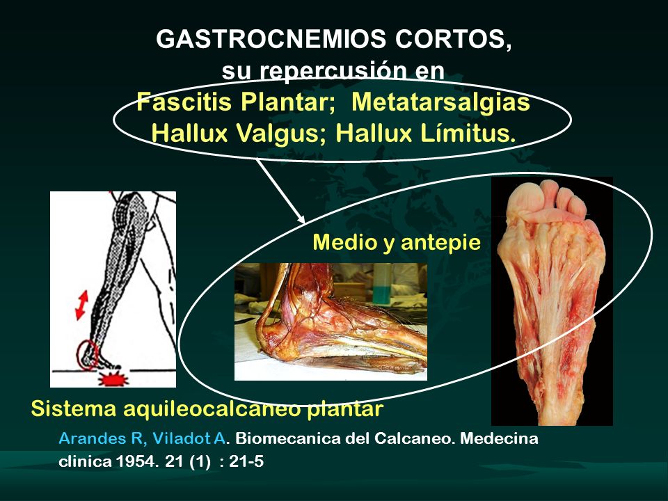 GASTROCNEMIOS CORTOS, su repercusión en Fascitis Plantar; Metatarsalgias Hallux Valgus; Hallux Límitus.