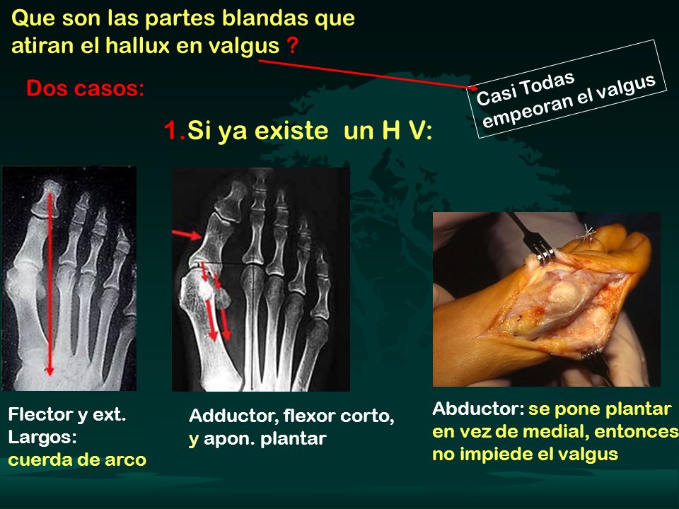Que son las partes blandas que atiran el hallux en valgus