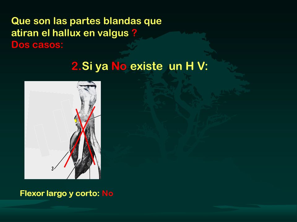Que son las partes blandas que atiran el hallux en valgus