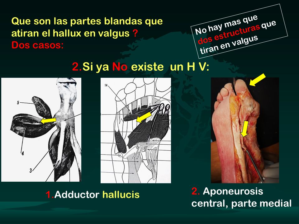 Que son las partes blandas que atiran el hallux en valgus