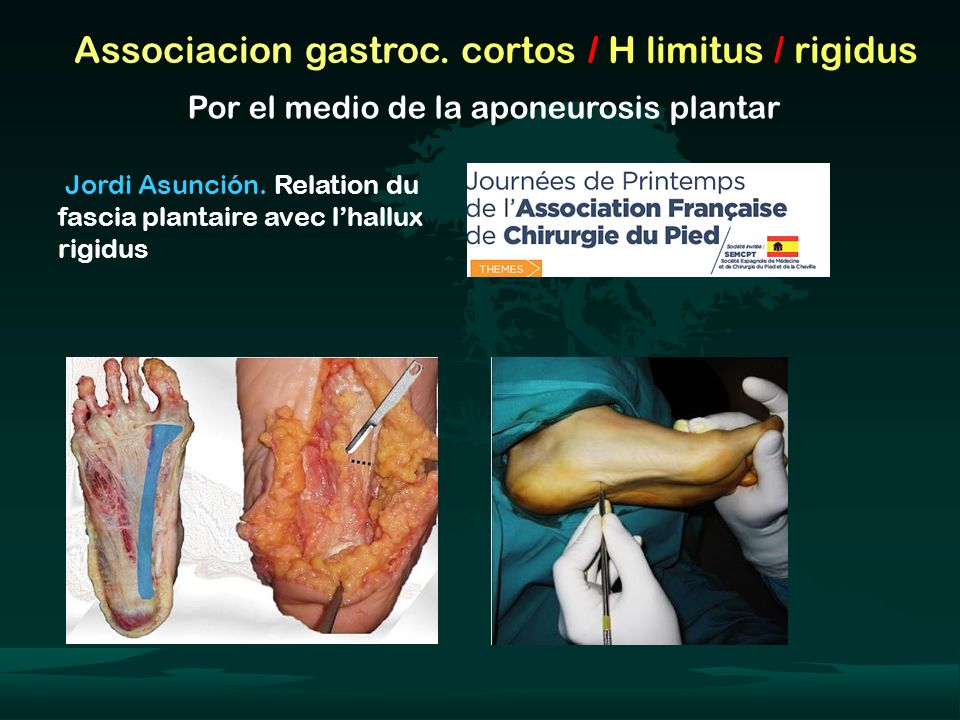 Associacion gastroc. cortos / H limitus / rigidus