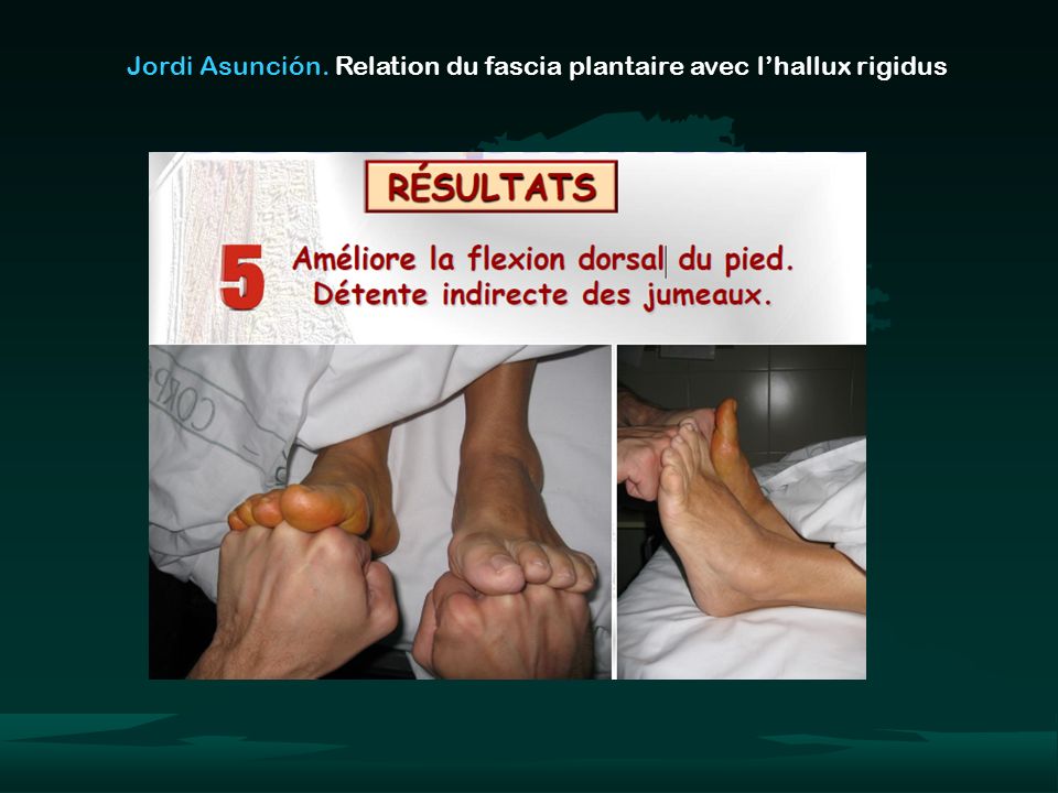 Jordi Asunción. Relation du fascia plantaire avec l’hallux rigidus