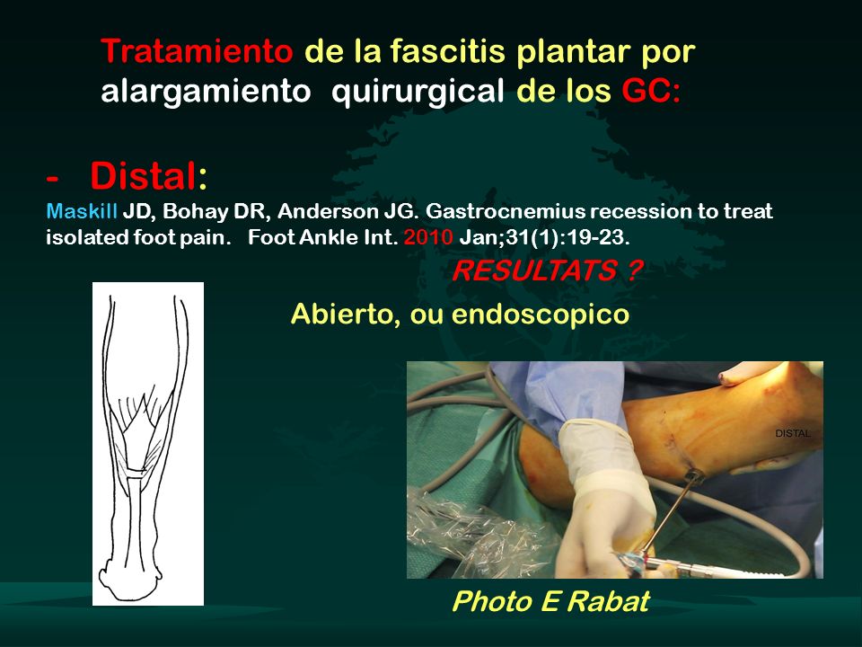 Tratamiento de la fascitis plantar por alargamiento quirurgical de los GC: