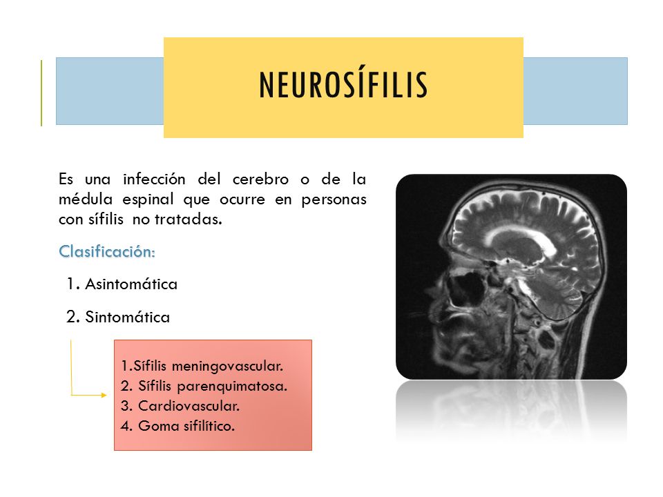 neurosífilis Es una infección del cerebro o de la médula espinal que ocurre en personas con sífilis no tratadas.