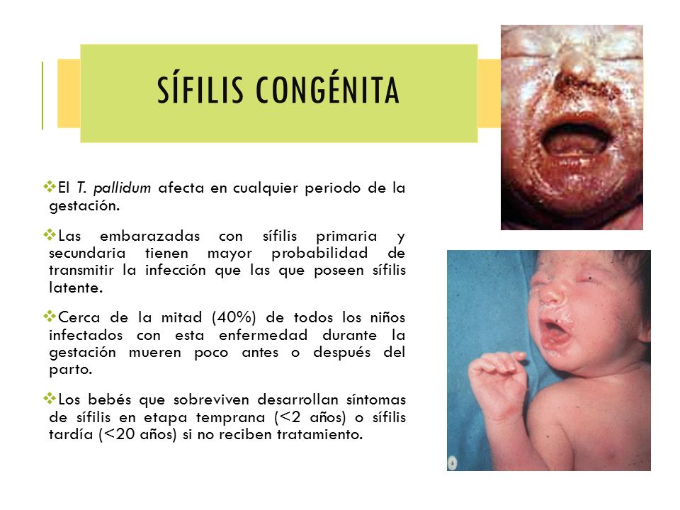 Sífilis congénita El T. pallidum afecta en cualquier periodo de la gestación.