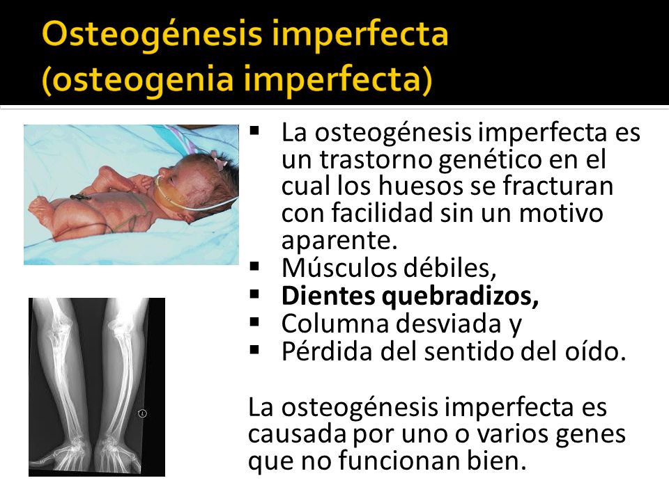 La osteogénesis imperfecta es un trastorno genético en el cual los huesos se fracturan con facilidad sin un motivo aparente.