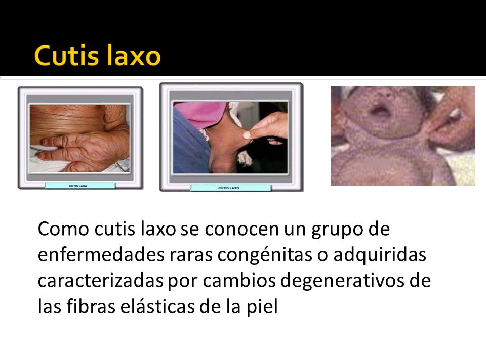 Como cutis laxo se conocen un grupo de enfermedades raras congénitas o adquiridas caracterizadas por cambios degenerativos de las fibras elásticas de la piel