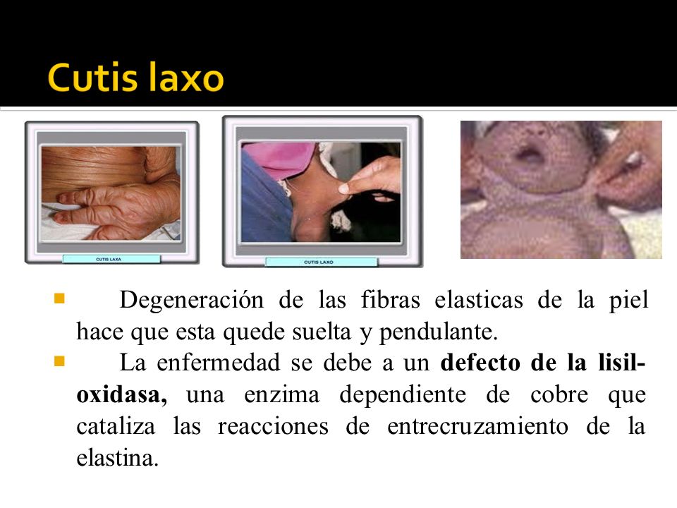  Degeneración de las fibras elasticas de la piel hace que esta quede suelta y pendulante.