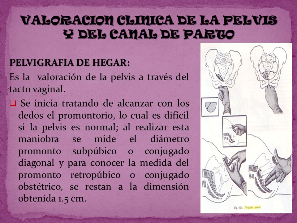 VALORACION CLINICA DE LA PELVIS Y DEL CANAL DE PARTO