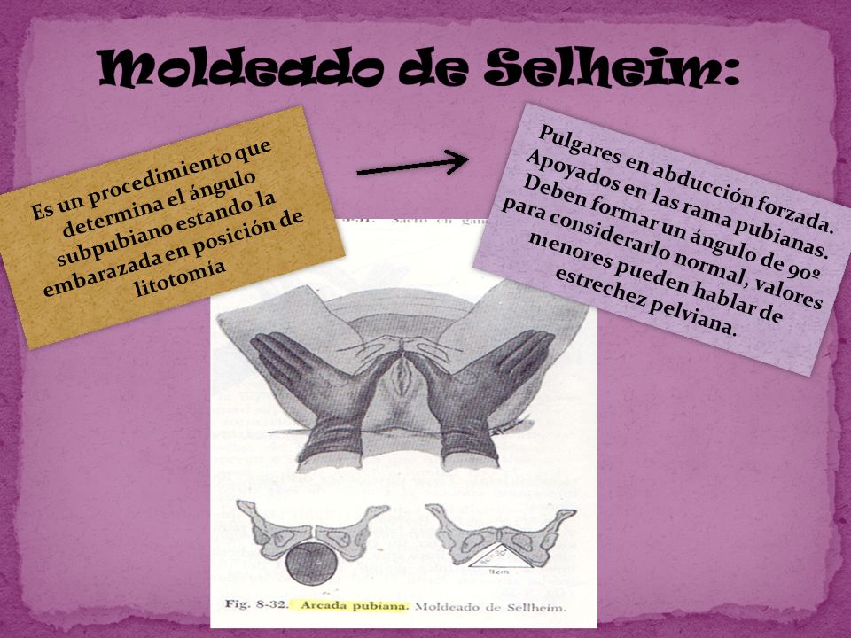 Moldeado de Selheim: Es un procedimiento que determina el ángulo subpubiano estando la embarazada en posición de litotomía.