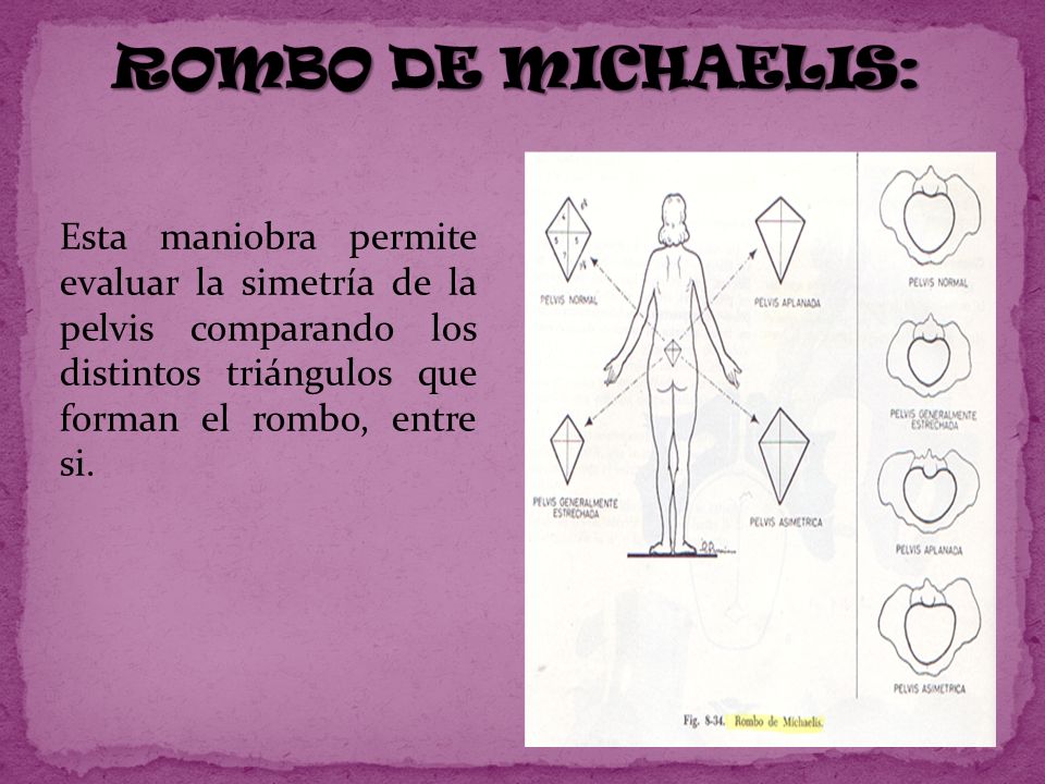 ROMBO DE MICHAELIS: Esta maniobra permite evaluar la simetría de la pelvis comparando los distintos triángulos que forman el rombo, entre si.