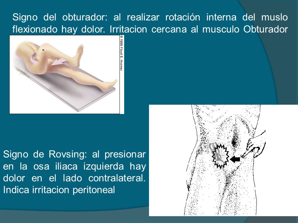 Signo del obturador: al realizar rotación interna del muslo flexionado hay dolor. Irritacion cercana al musculo Obturador interno.