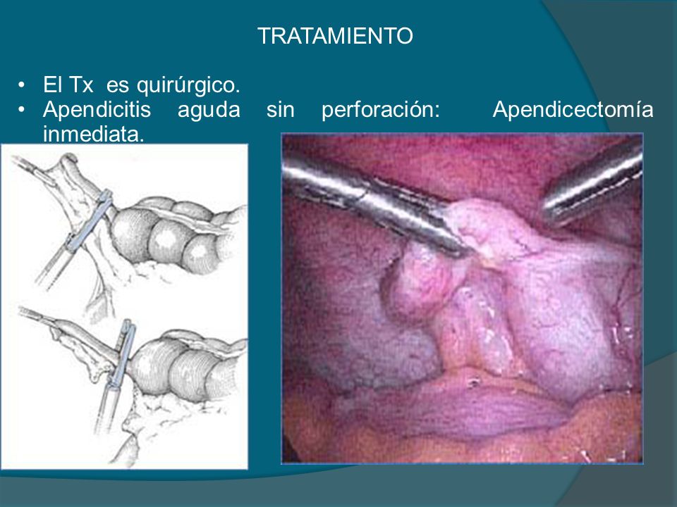 TRATAMIENTO El Tx es quirúrgico. Apendicitis aguda sin perforación: Apendicectomía inmediata.
