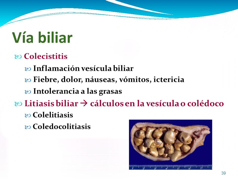 Vía biliar  Litiasis biliar  cálculos en la vesícula o colédoco