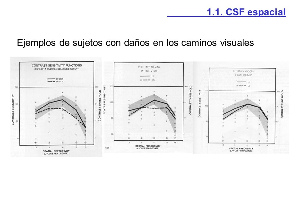 1.1. CSF espacial Ejemplos de sujetos con daños en los caminos visuales
