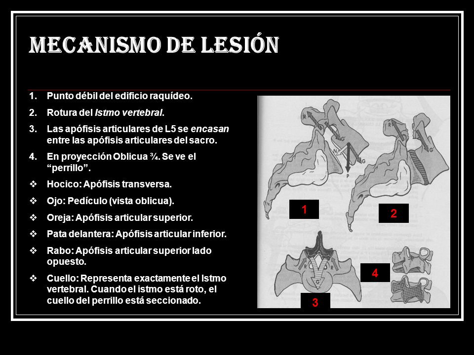 Mecanismo de lesión Punto débil del edificio raquídeo.