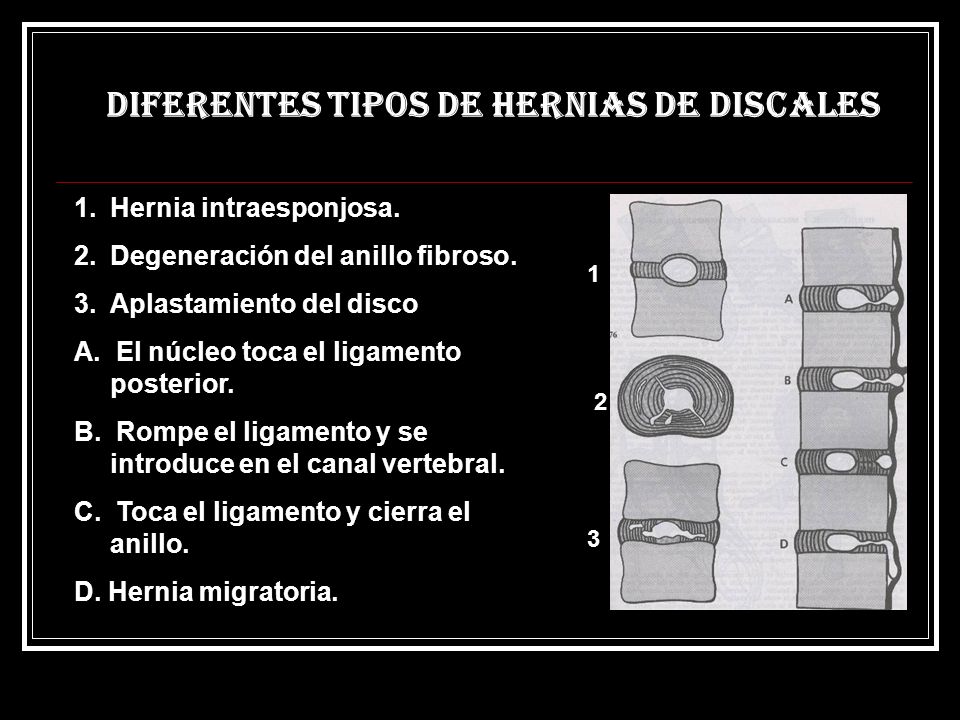 DIFERENTES TIPOS DE HERNIAS DE DISCALES