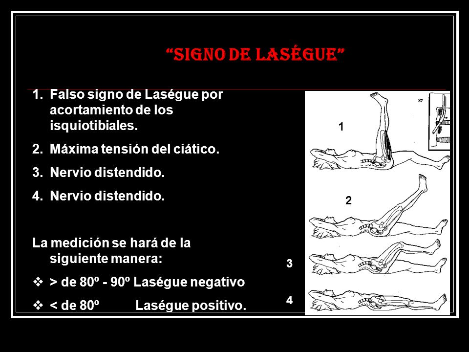 SIGNO DE LASÉGUE Falso signo de Laségue por acortamiento de los isquiotibiales. Máxima tensión del ciático.