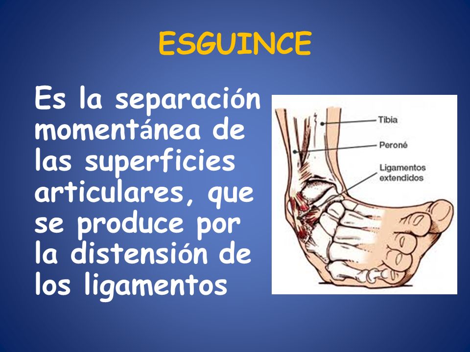 ESGUINCE Es la separación momentánea de las superficies articulares, que se produce por la distensión de los ligamentos.