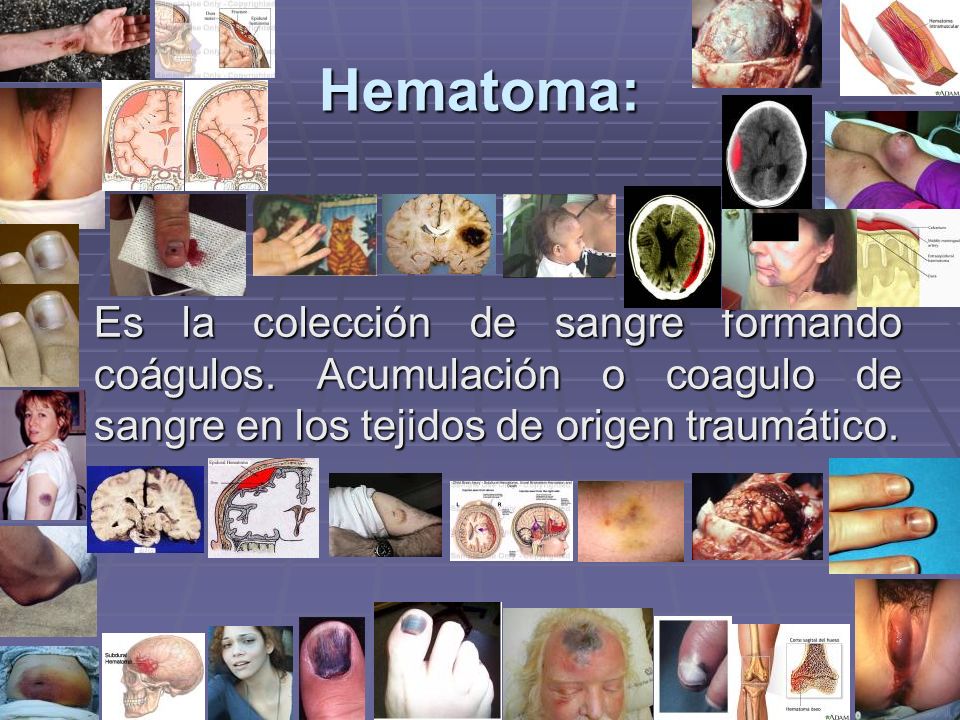 Hematoma: Es la colección de sangre formando coágulos.