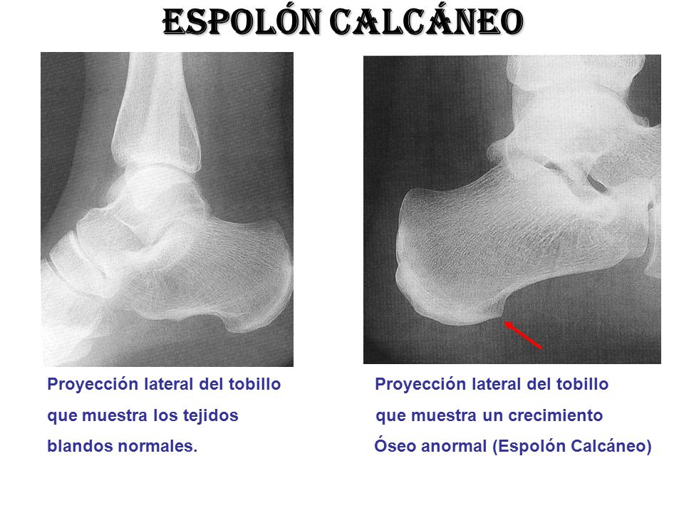 Espolón calcáneo Proyección lateral del tobillo Proyección lateral del tobillo.