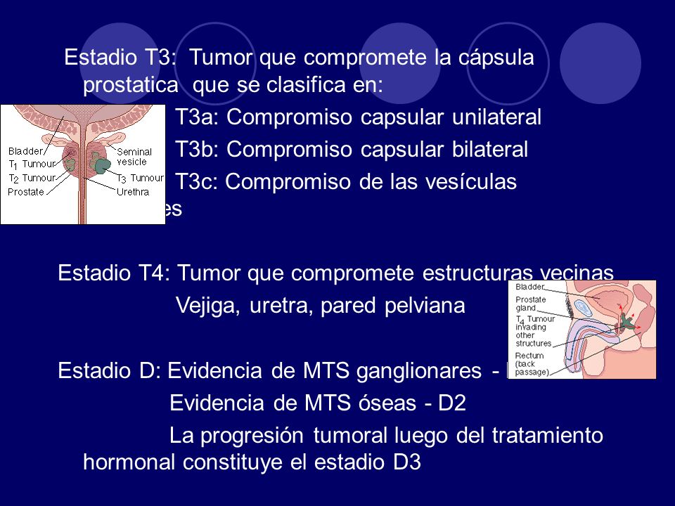 Estadio T3: Tumor que compromete la cápsula prostatica que se clasifica en: