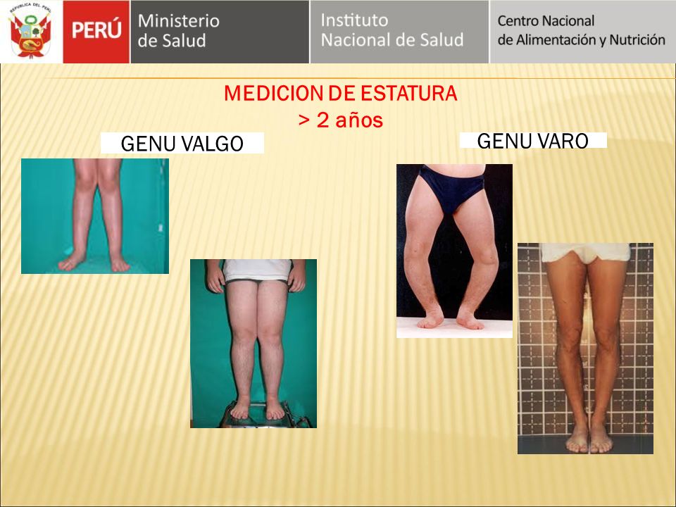 MEDICION DE ESTATURA > 2 años GENU VALGO GENU VARO