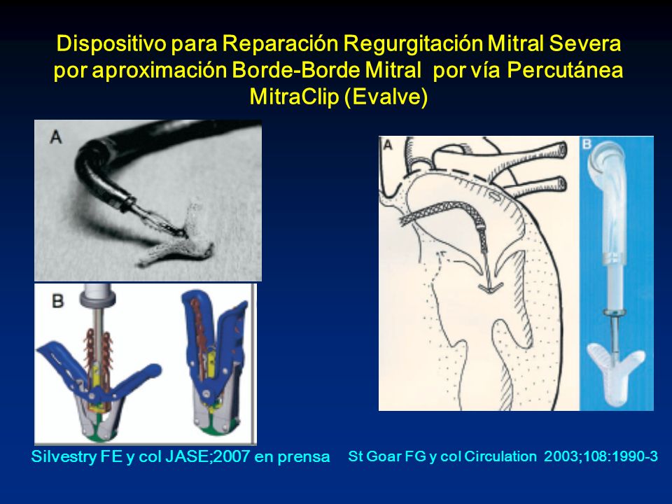 Dispositivo para Reparación Regurgitación Mitral Severa por aproximación Borde-Borde Mitral por vía Percutánea MitraClip (Evalve)