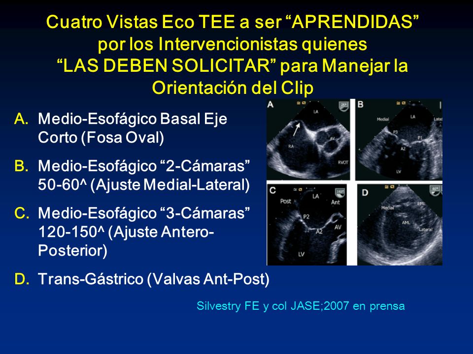 Cuatro Vistas Eco TEE a ser APRENDIDAS por los Intervencionistas quienes LAS DEBEN SOLICITAR para Manejar la Orientación del Clip