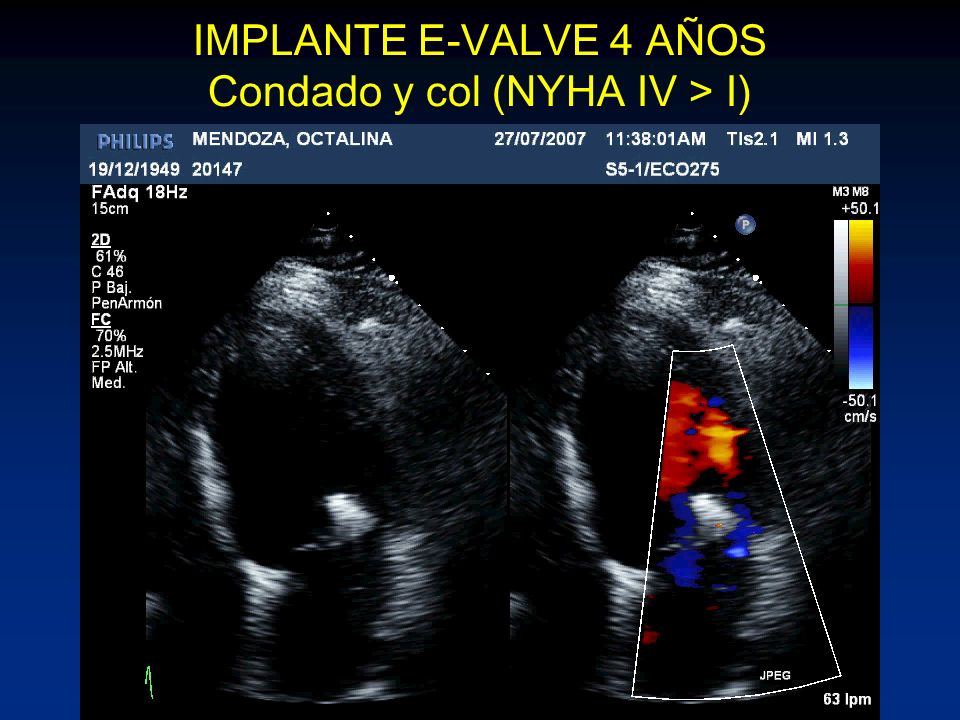 IMPLANTE E-VALVE 4 AÑOS Condado y col (NYHA IV > I)