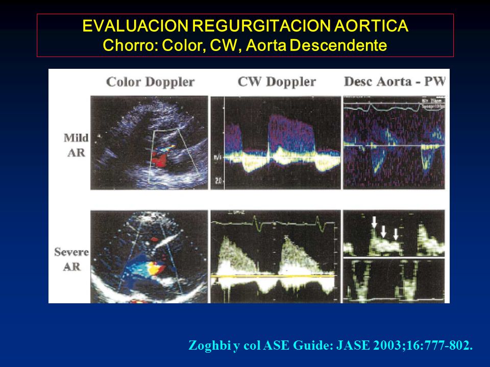 EVALUACION REGURGITACION AORTICA Chorro: Color, CW, Aorta Descendente
