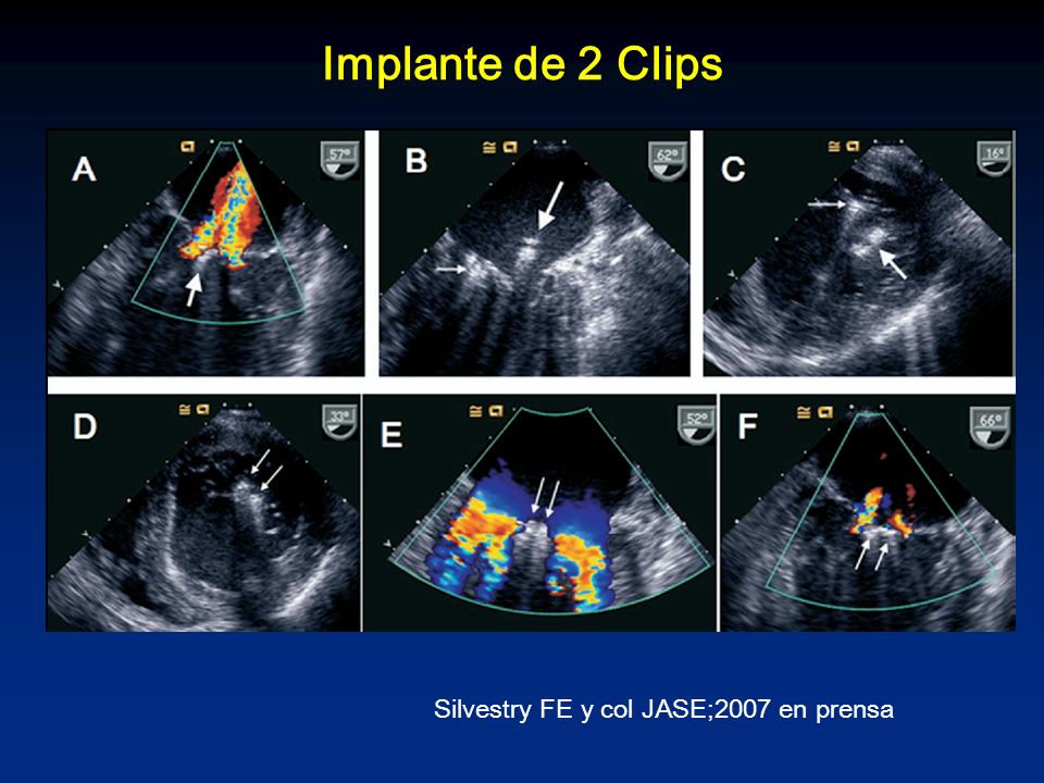 Implante de 2 Clips Silvestry FE y col JASE;2007 en prensa