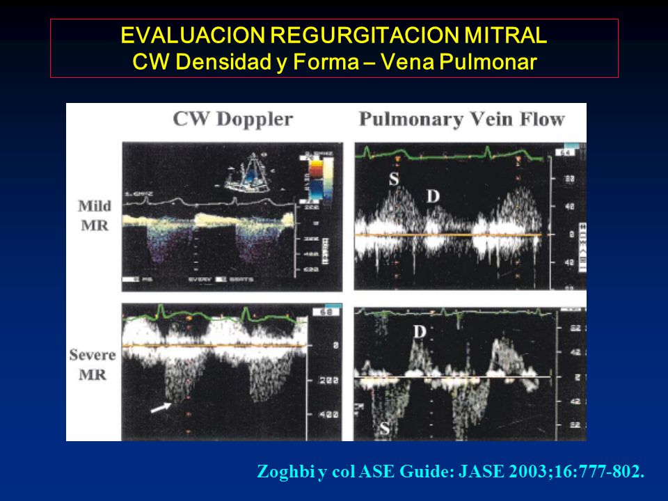 EVALUACION REGURGITACION MITRAL CW Densidad y Forma – Vena Pulmonar