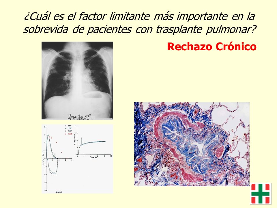 ¿Cuál es el factor limitante más importante en la sobrevida de pacientes con trasplante pulmonar