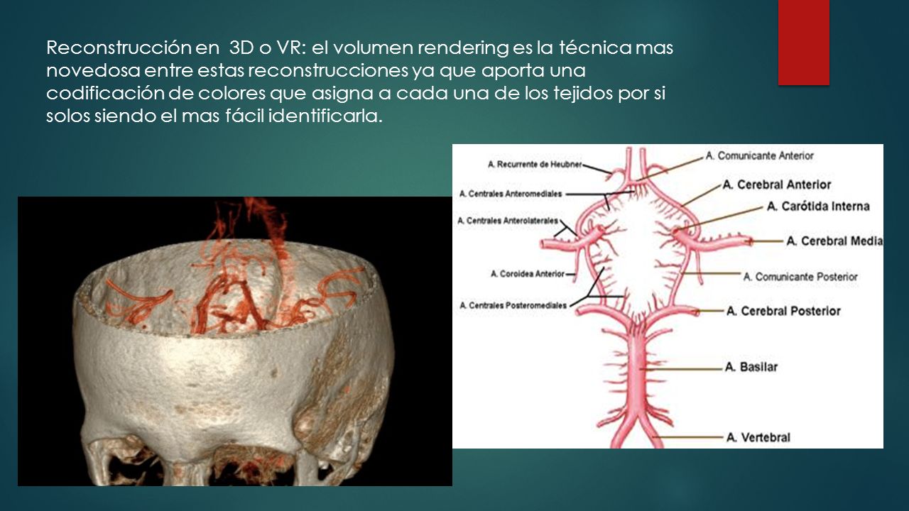 Reconstrucción en 3D o VR: el volumen rendering es la técnica mas novedosa entre estas reconstrucciones ya que aporta una codificación de colores que asigna a cada una de los tejidos por si solos siendo el mas fácil identificarla.
