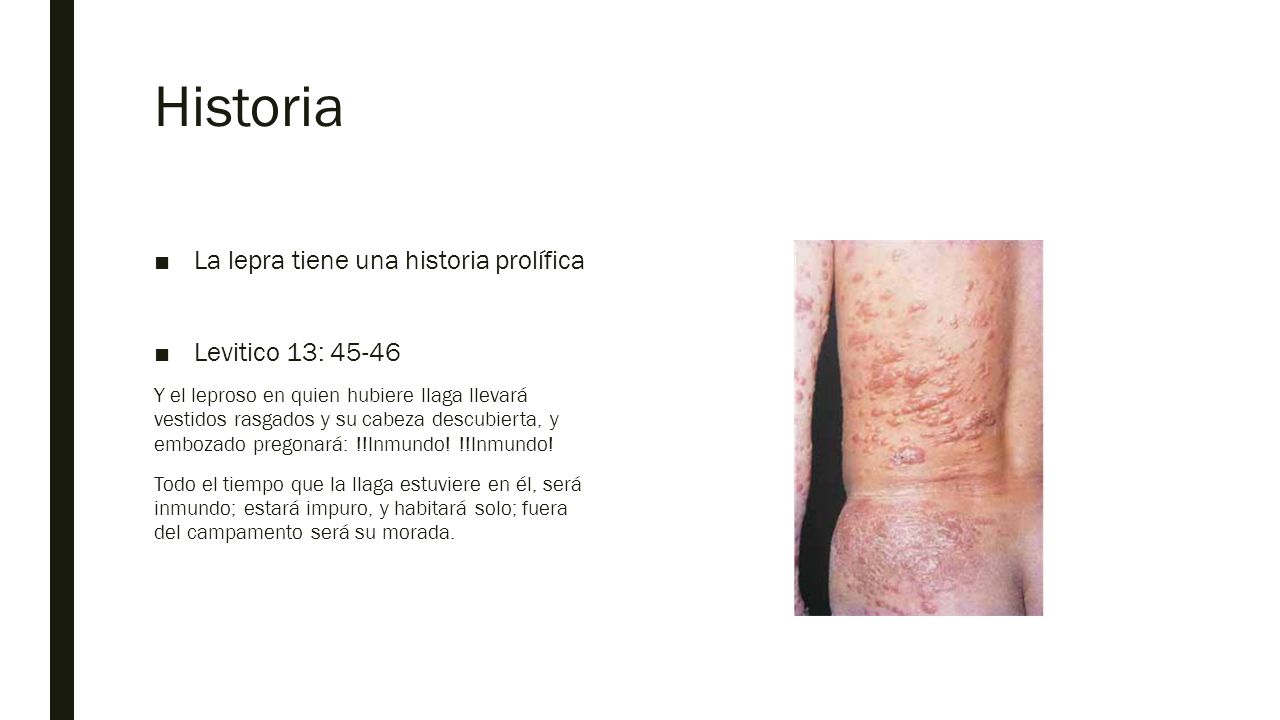 Historia La lepra tiene una historia prolífica Levitico 13: 45-46