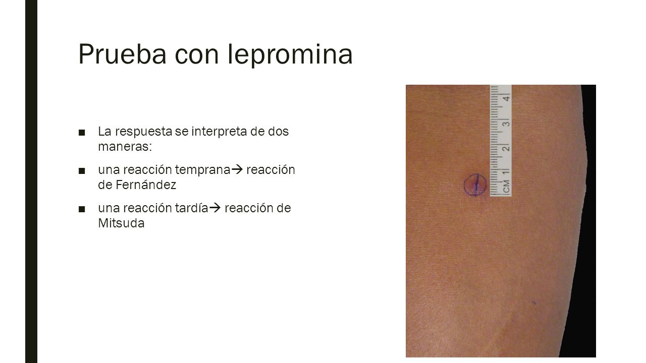 Prueba con lepromina La respuesta se interpreta de dos maneras: