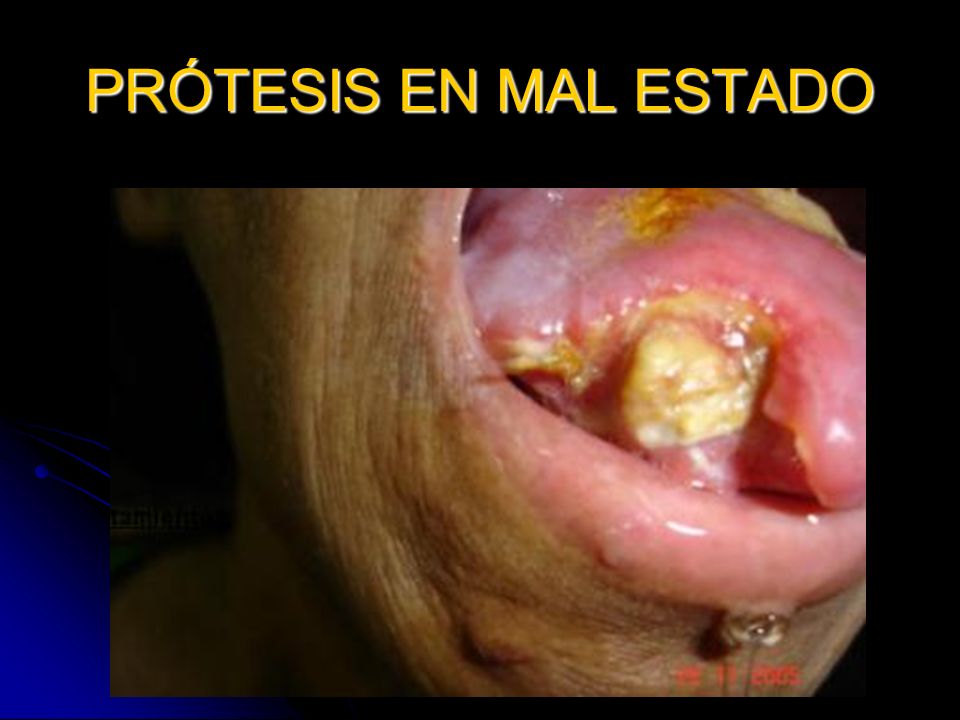 PRÓTESIS EN MAL ESTADO