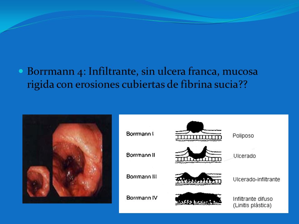 Borrmann 4: Infiltrante, sin ulcera franca, mucosa rigida con erosiones cubiertas de fibrina sucia